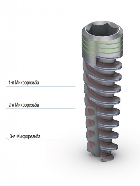 Имплантат BIOLINE (BDI)